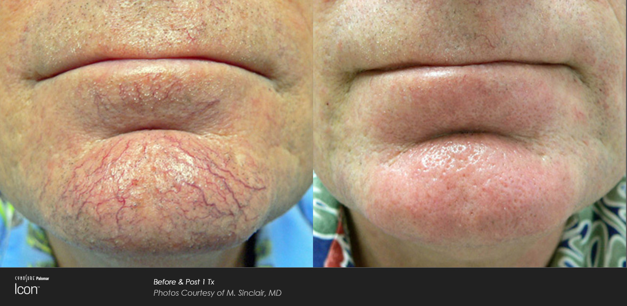 Vein Treatment IPL before and after