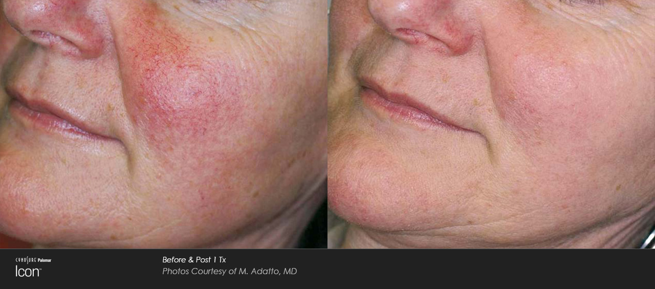 Rosacea IPL before and after